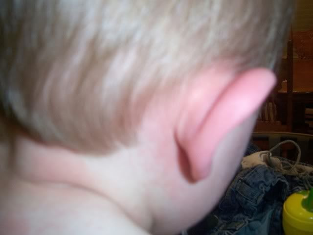 heat rash on face pictures. newborn heat rash on face.