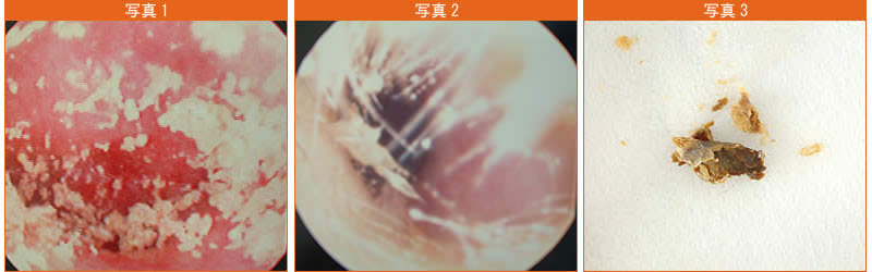 耳垢のとりかた たけざわ耳鼻咽喉科