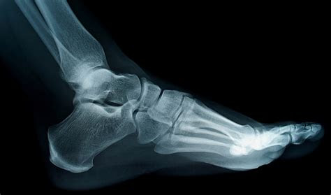 Plantar fasciitis is a pain disorder which affects the heel and the bottom of the foot and is the most common cause of foot pain. A common issue with sprained ankles - Students 4 Best Evidence
