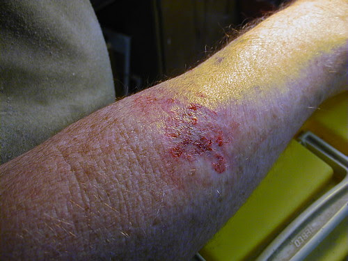 Surgical Excision Tattoo Removal | Tattoo Removal