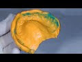 Digital Denture Digital Dentistry