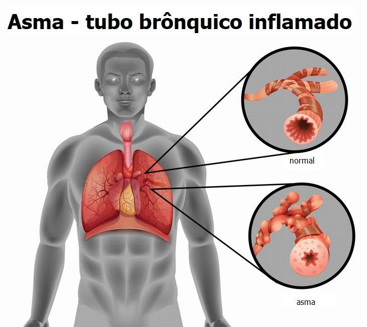 Sinusite recorrente