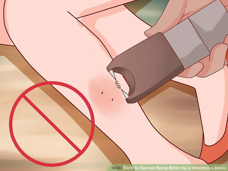 Survive Being Bitten by a Venomous Snake Step 11 Version 2.jpg