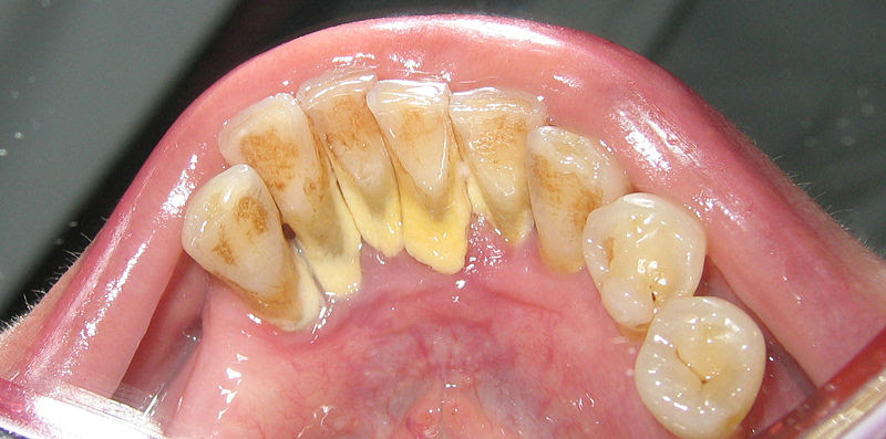 Calculus (dental) - wikidoc