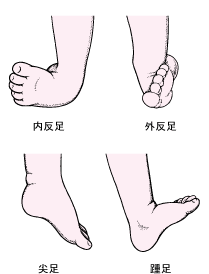 内反足専門外来 江東区東大島の整形外科 Antiquetinno1のblog