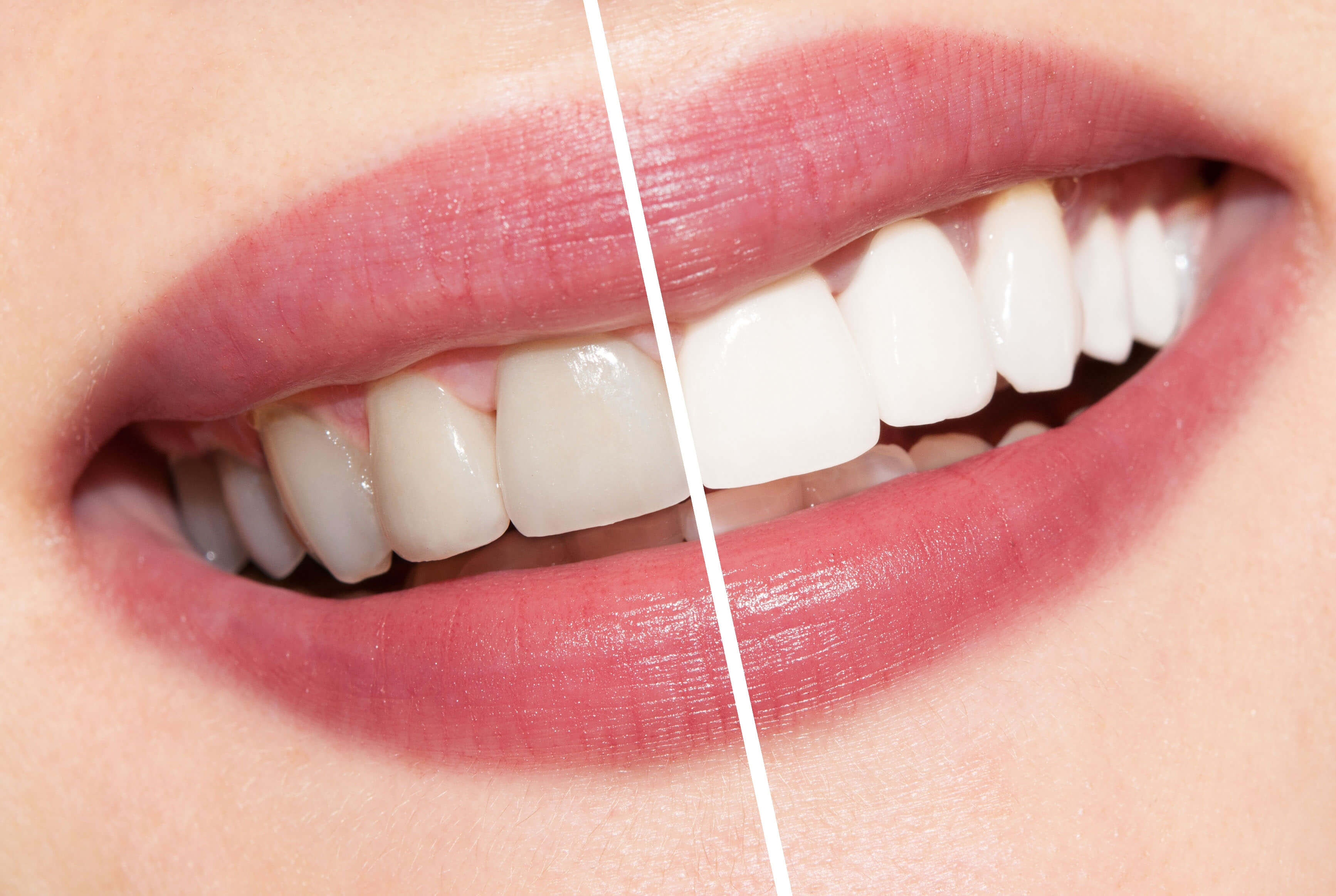 Good teeth whiteners