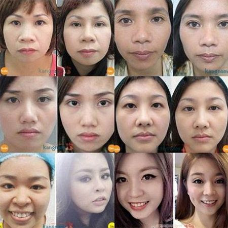 Cắt mắt 2 mí bao nhiêu tiền? Ý kiến của khách hàng