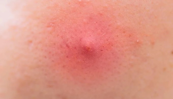 Skin Cancer Arm - Loosened Mole Looks Like It Can Be Flicked Off Â» Scary : Skin cancer is by far the most common type of cancer.