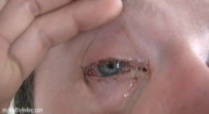 Are Systane Eye Drops Over The Counter / Is Cataract Surgery Painful? - www.scottsdaleeye.com : When this occurs it is called glaucoma.