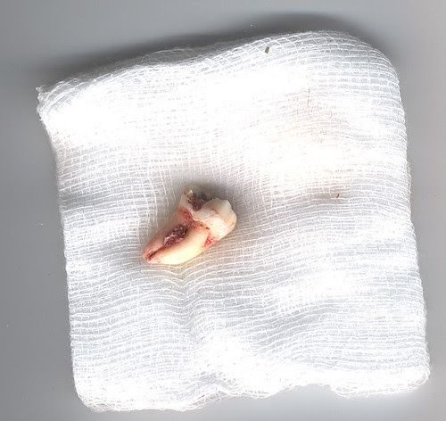 Tooth filling fell out pain relief