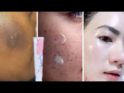 Top 1 cream for melasma, Hyperpigmentation, uneven skin and Dull skin | Brijwasi Girl | Skin care