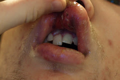 tooth implant