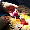 Prostate Cancer Treatment Breakthrough : Kathy's MRI Pathology Blog: Metastatic epidural spinal - Although screenings for prostate cancer are one tool for early detecti.