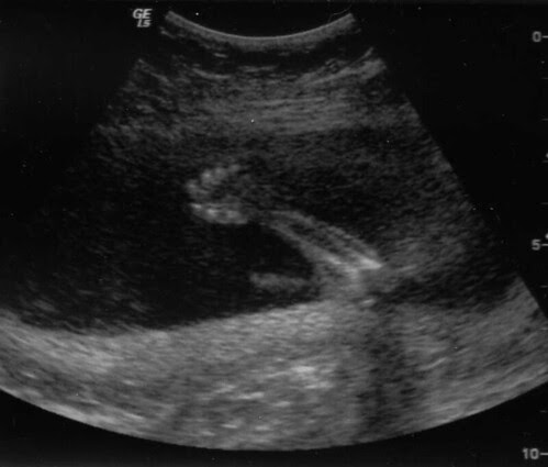 Ultrasound #2 taken @19.5 weeks
