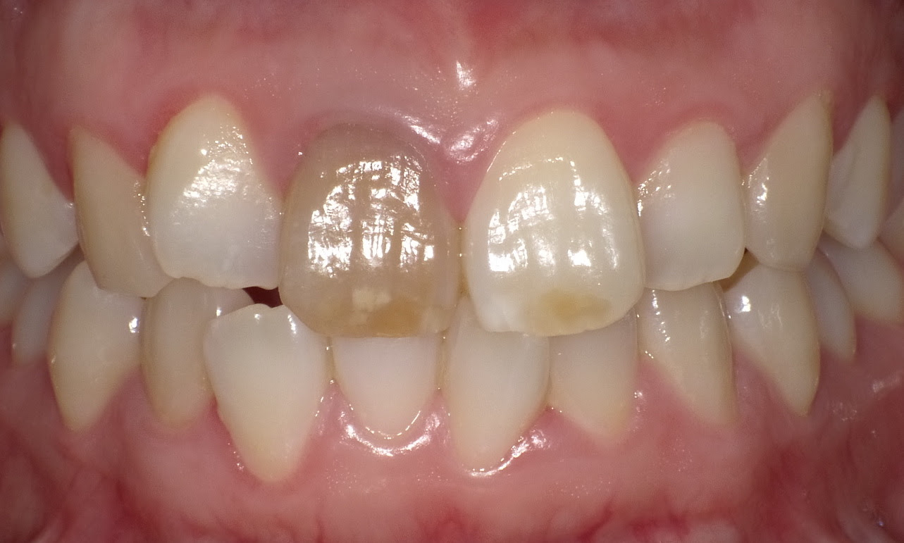 神経の死んだ変色歯のホワイトニング 漂白 インターナル ウォーキング ブリーチのご紹介 さいたま市緑区 浦和区 歯医者 歯科 伏見歯科医院