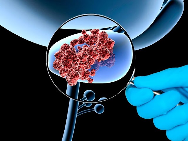 Prostate Cancer Medscape - PSMA PET/CT beats standard scan at prostate cancer detecting