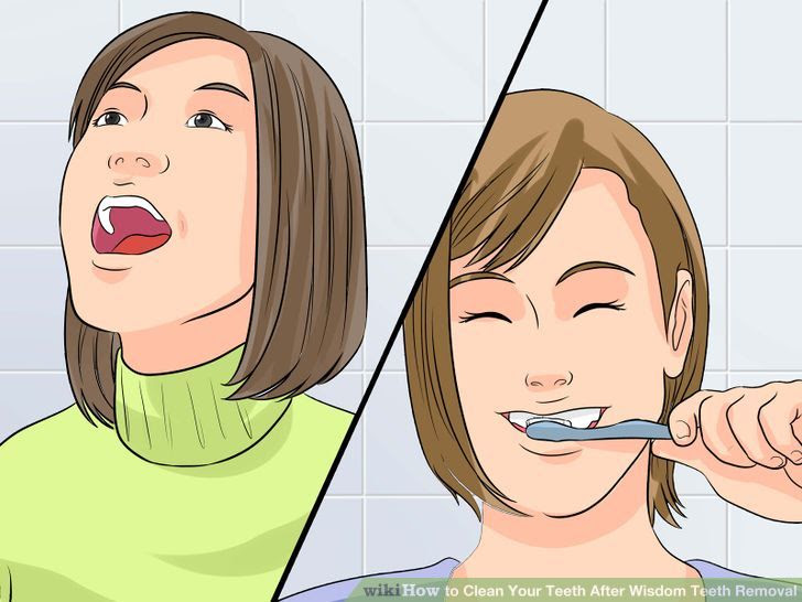 Clean Your Teeth After Wisdom Teeth Removal Step 5 Version 2.jpg