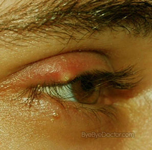 Stye Eye