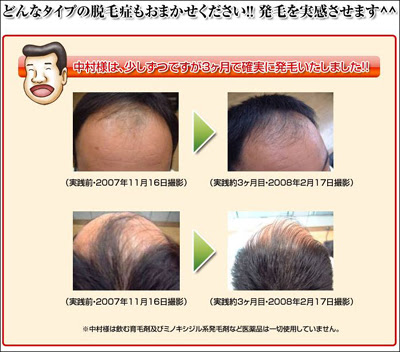 Hsp発毛プログラム 近藤成哉 レビュー 評価 髪の毛 生える