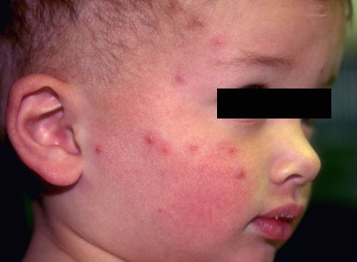 Exaggerated insect bite reaction, possibly secondary to chigger bites