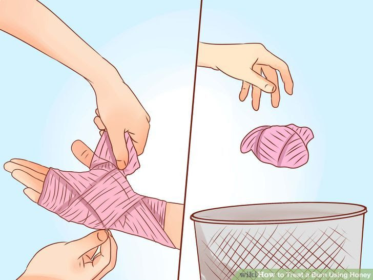 Treat a Burn Using Honey Step 11.jpg
