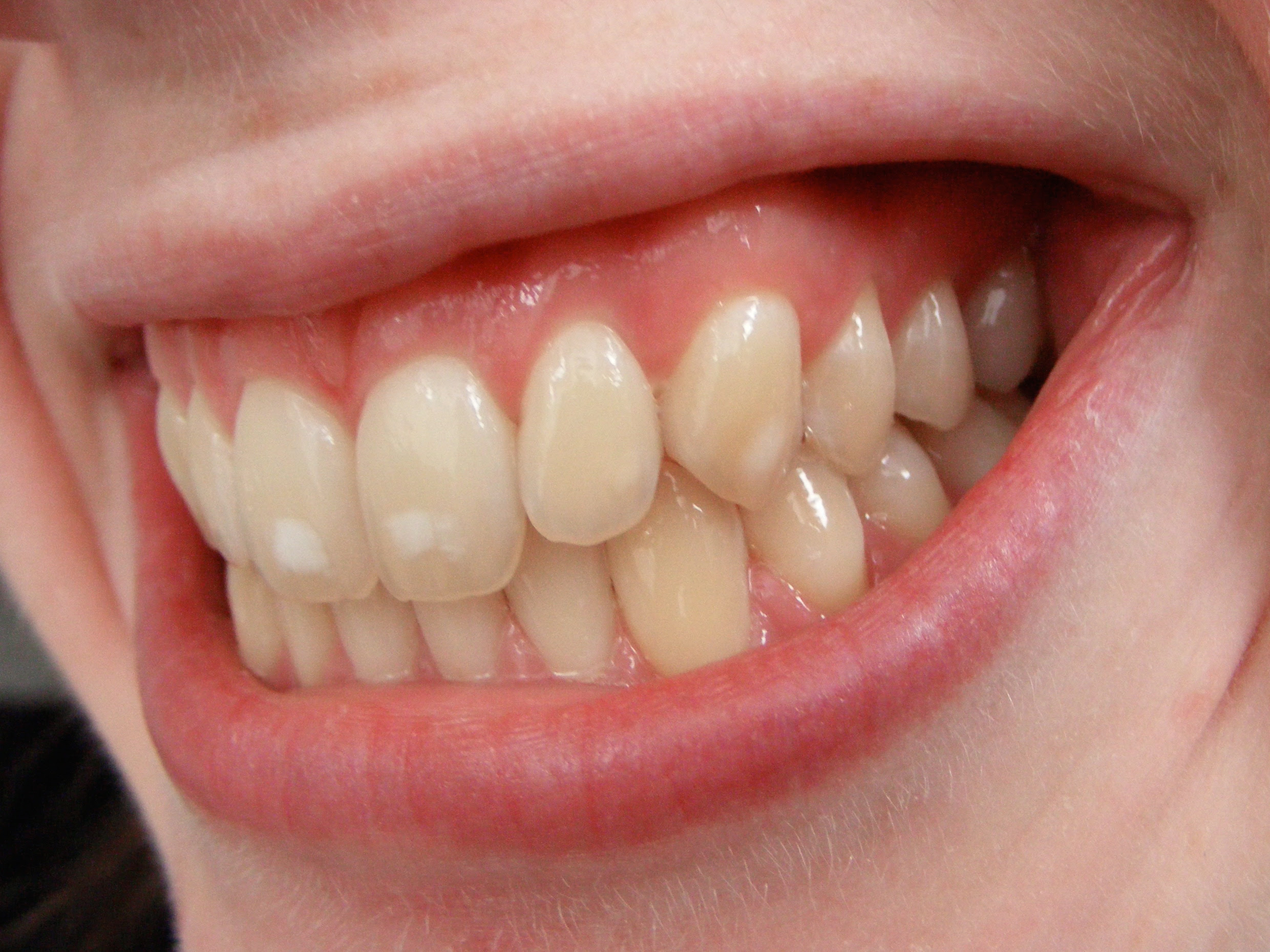 Fluoride in Water - Aquatec - Pure Water People