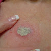 Does Skin Cancer Mole Hurt / Raise Moles on Face, Back, Red Raised Mole, Removal, Itchy / Common causes range from illness to injury to inflammation.