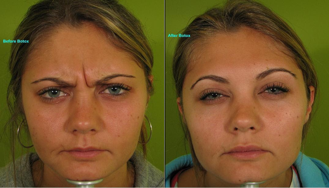 frown lines botox before and after - DriverLayer Search Engine