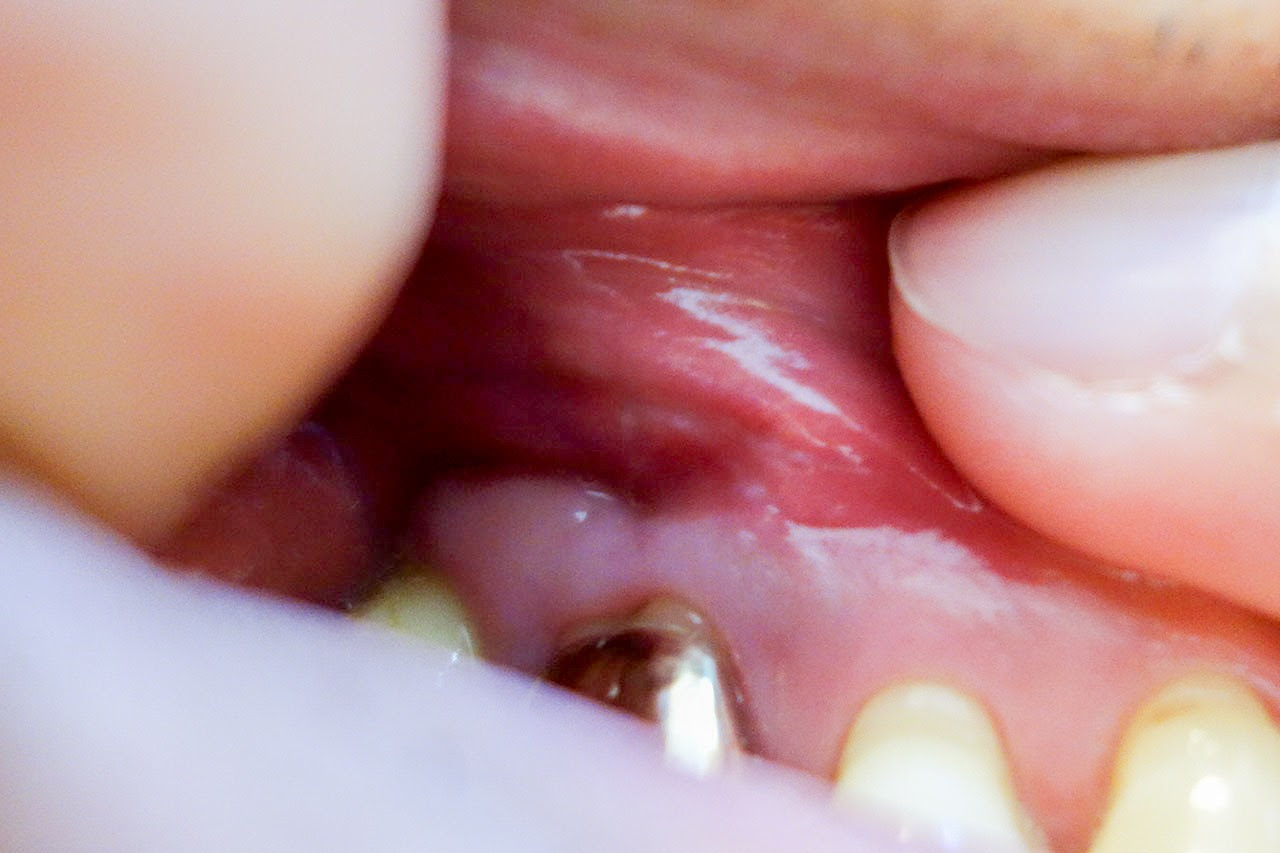 治療しても歯茎の膿が再発するので歯茎を切開する手術を受けた 体験談 Drk7jp