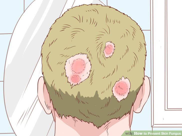 Prevent Skin Fungus Step 12.jpg