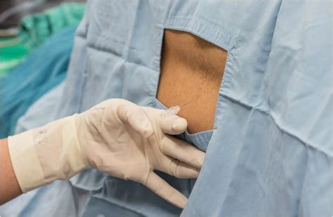 Wendy bumgardner is a freelance writer covering walking and other health and fitness. Facet Joint Injections - Sound Pain Alliance - Our Treatments