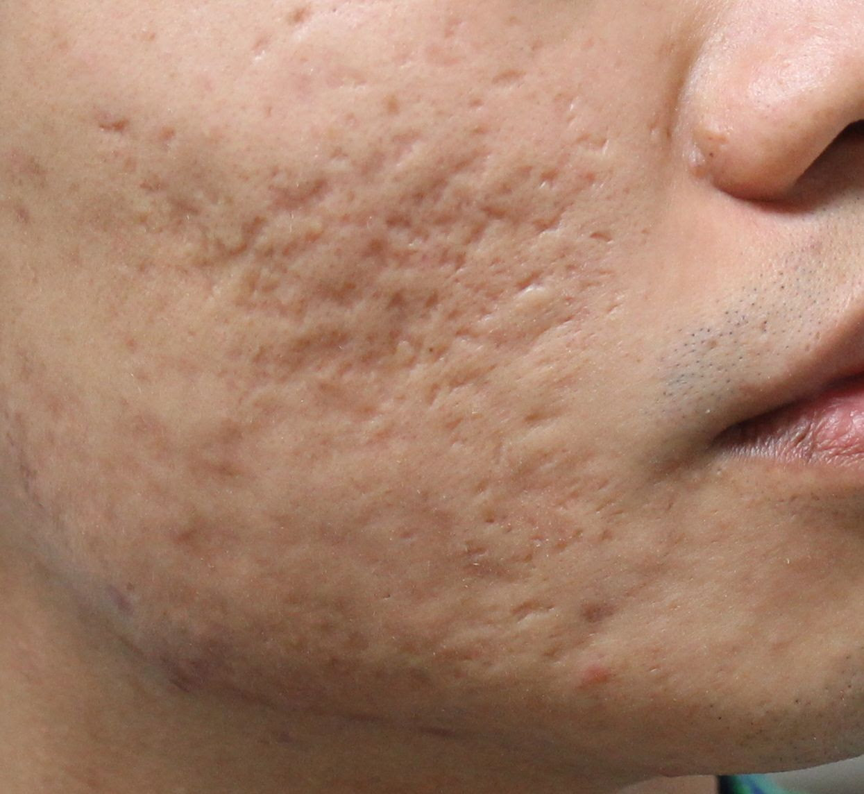 OFFICIAL ACNE SCAR SOLUTIONS; Q\u0026A \/ FAQ \u0026gt;\u0026gt;READ
BEFORE POSTING