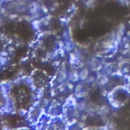 Surgeons test possible stem cell cure for blindness