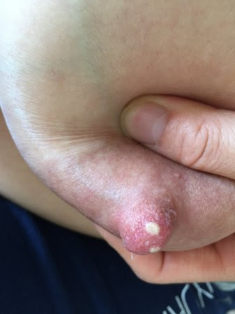 Milk Bleb Blister Help Pic Babycenter