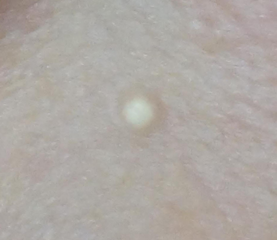 ホクロ イボ Co2レーザー 皮膚科 内科 美容皮膚科を肥後橋でお探しなら江戸堀サンテクリニック