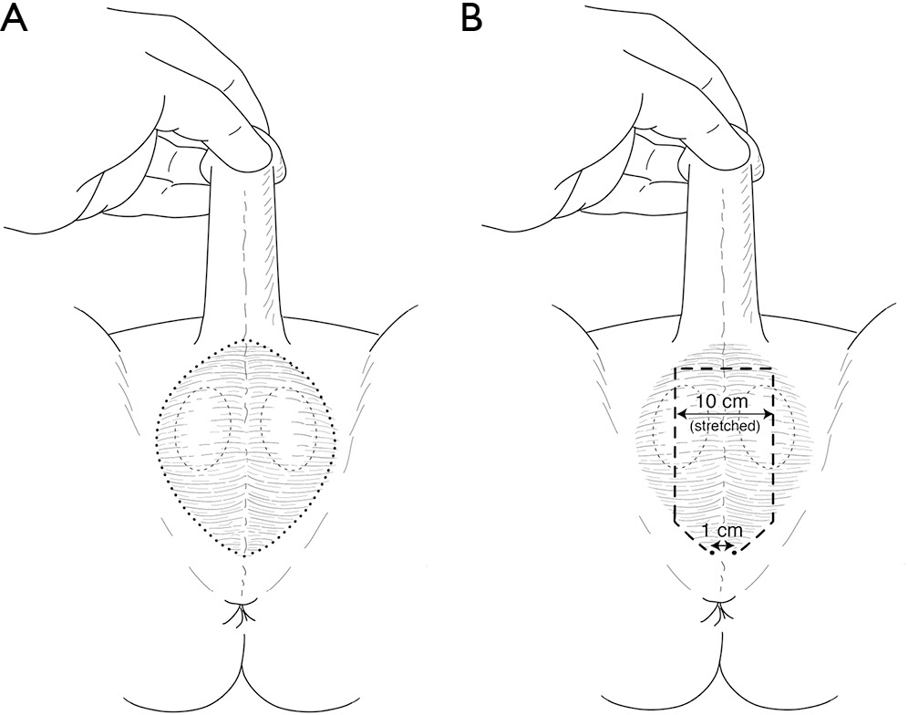 Laser Hair Removal For Genital Gender Affirming Surgery Zhang