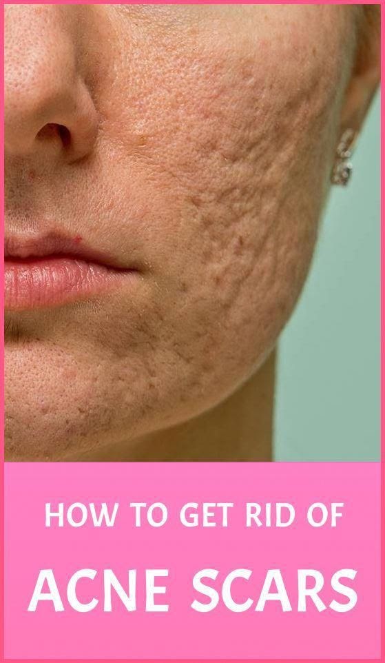 Skin Cancer Biopsy Types - Parasites: See What's Eating Your Skin : It may grow slowly and it's typically treatable.