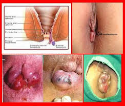 cara menyembuhkan ambeien