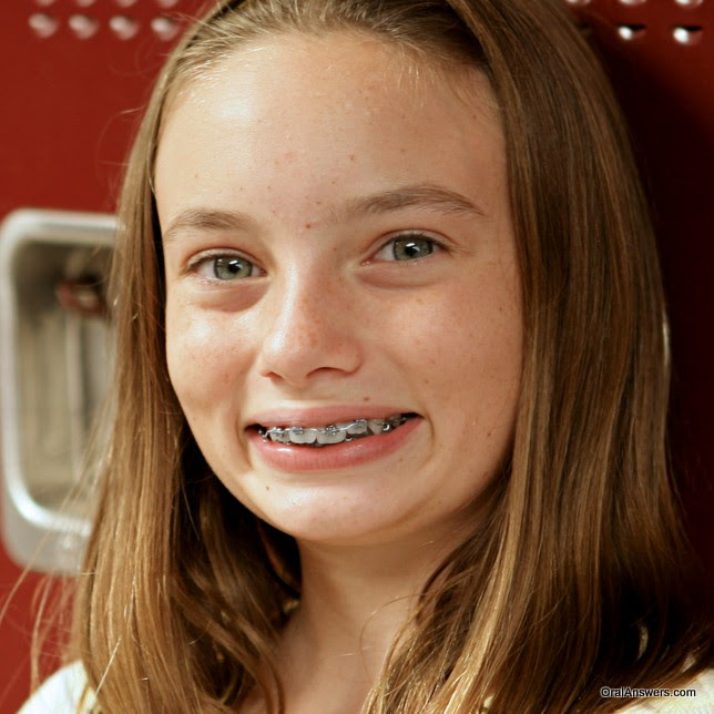 teenager_braces_at_school