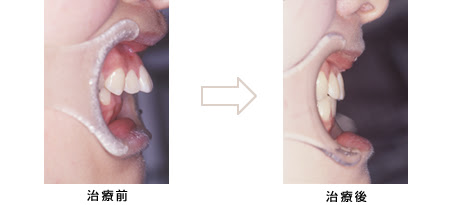 上顎前突 出っ歯 前歯の突出 本庄市の矯正歯科 歯列 歯並び 専門医院