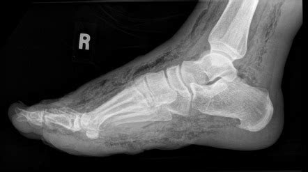 Plantar fasciitis is a pain disorder which affects the heel and the bottom of the foot and is the most common cause of foot pain. Necrotising faciitis in a diabetic foot | Image