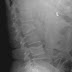 Multiple Myeloma Radiology - Multiple myeloma | Radiology Reference Article ... / Multiple myeloma is the most common primary malignant neoplasm of the skeletal system.