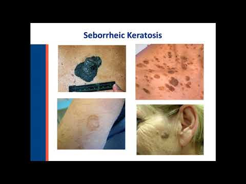 View 10 Benign Skin Cancer
