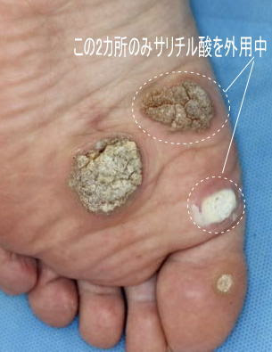 高濃度サリチル酸ワセリン軟膏