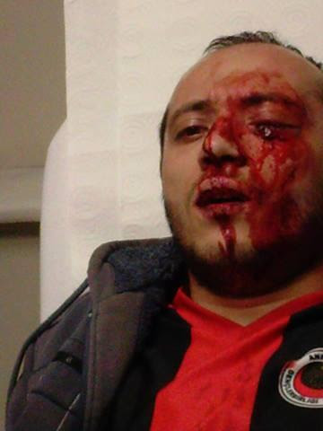 occupygezipic:

A man loses an eye after he is hit with  a gas spray canister. 