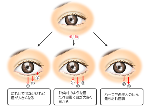 グラマラスライン 結膜側 術後に起こりうるトラブル 対応 テキスト版 美容外科 大百科事典