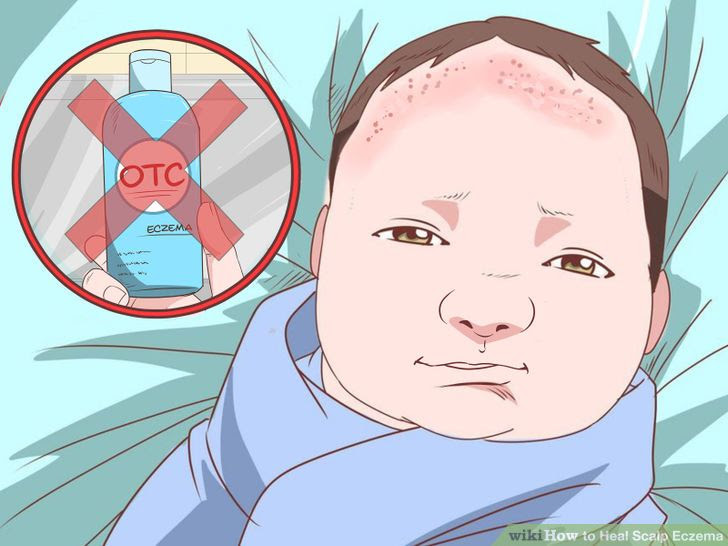 Heal Scalp Eczema Step 18 Version 3.jpg
