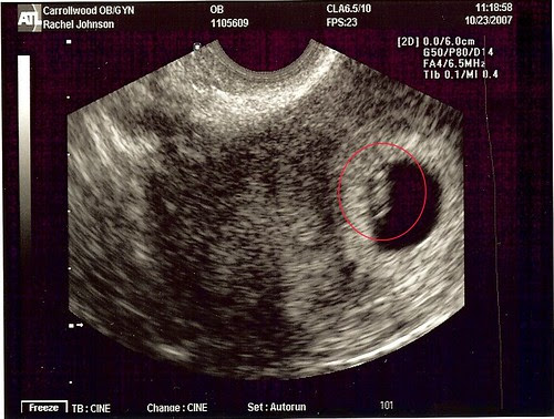 sonogram 5 weeks. for ultrasound - 5 weeks; sonogram 5 weeks. First Ultrasound at 5 weeks