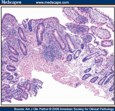 Ileitis crohn