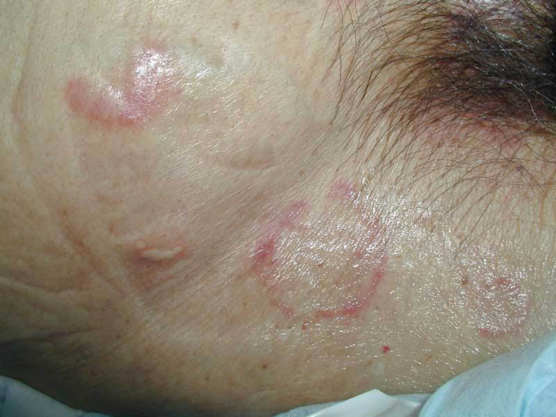Low Tech Telemedicine Dermatology